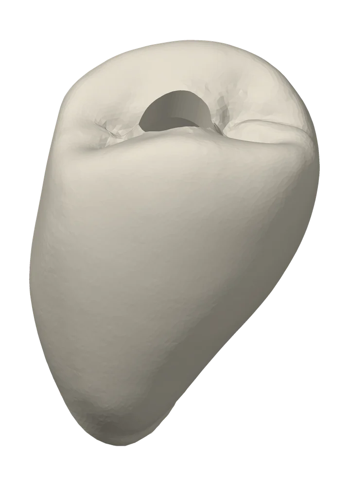 PMMA temporary crown seen from the buccal, the intaglio shaped to the final abutment it seats onto